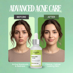 Anti-Acne Serum