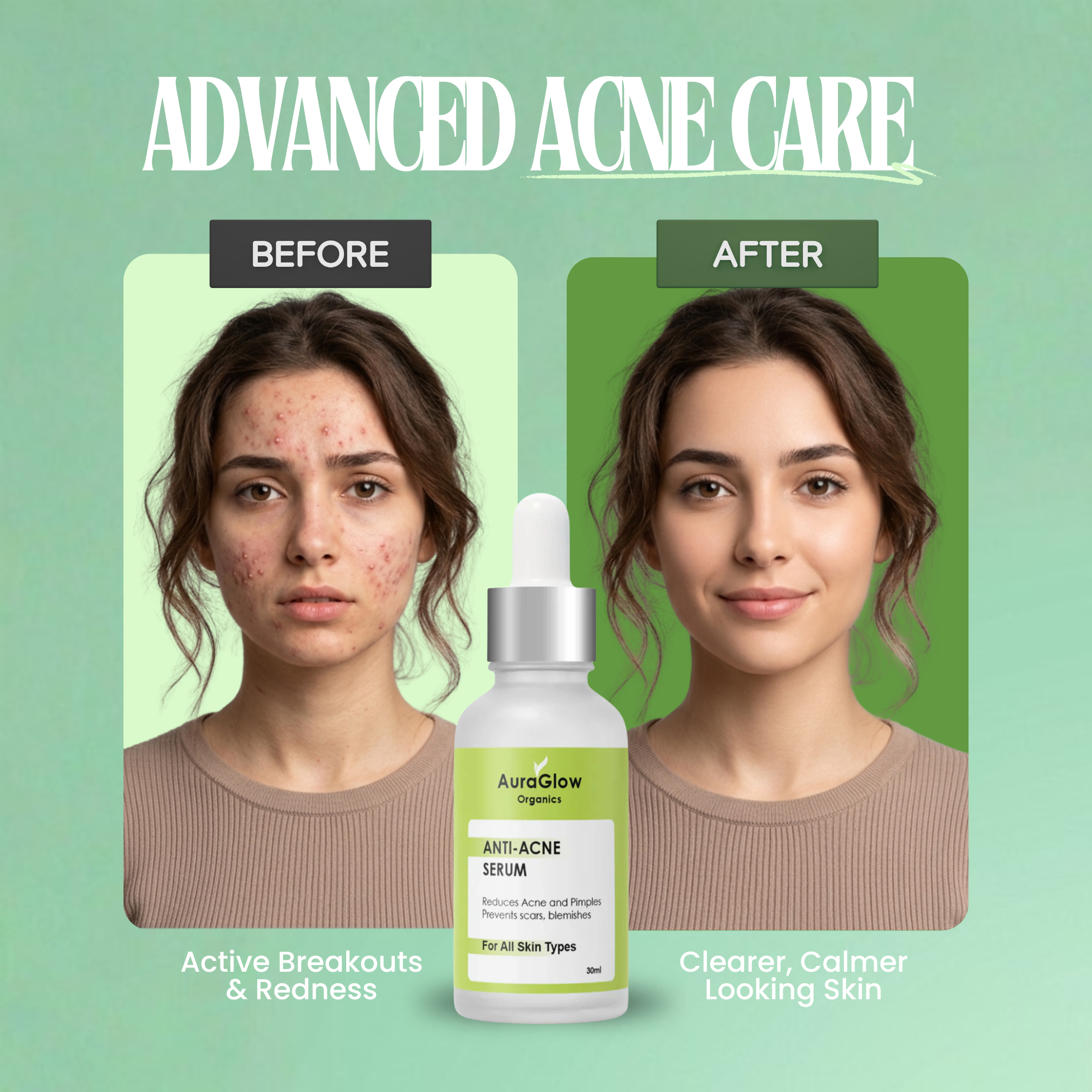 Anti-Acne Serum